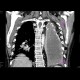 Empyema of the thorax: CT - Computed tomography